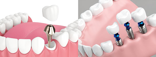差し歯とインプラントって何が違うの？